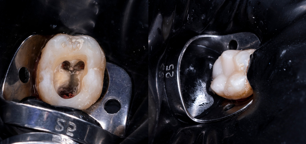 dental composite restoration after root canal treatment